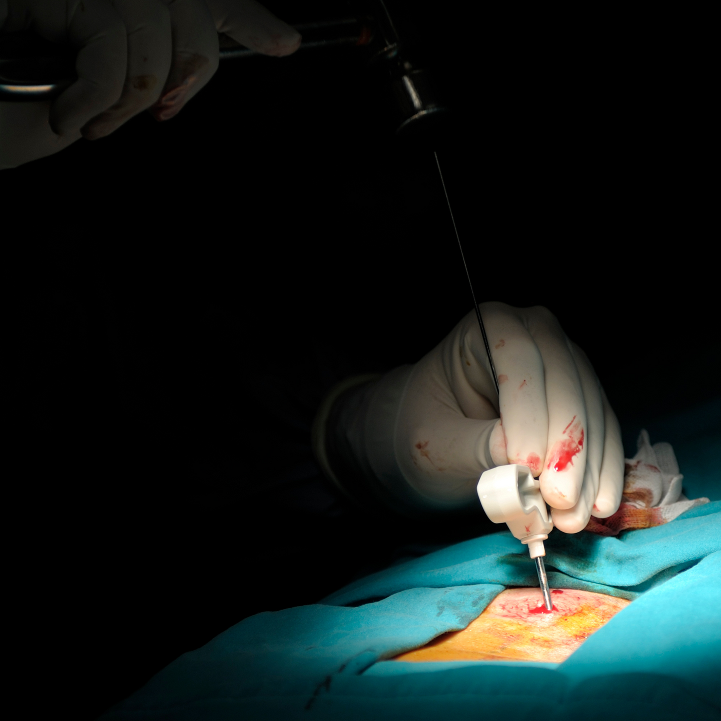 Vertebroplastica e Cifoplastica